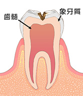 虫歯C2