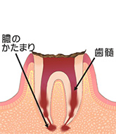 虫歯C4